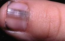 엄지 발가락 손톱이 검게 변합니다.